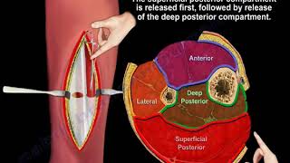 Acute and chronic leg Compartment Syndrome  Everything You Need To Know  Dr Nabil Ebraheim [upl. by Reg]