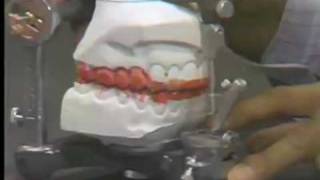 Occlusal Adjustment  Centric Relation [upl. by Tiraj209]