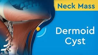 Neck Cyst Dr Khaled Sadek [upl. by Asilaj]