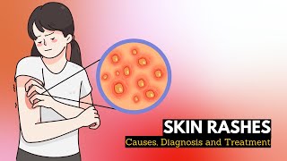 Skin Rash Causes Signs and Symptoms Diagnosis and Treatment [upl. by Nnylsoj]