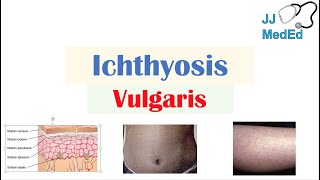 Ichthyosis Vulgaris  Causes Signs amp Symptoms Diagnosis Treatment [upl. by Kelula]