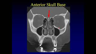 Imaging of the Paranasal Sinuses 1 [upl. by Allianora888]