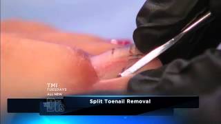 How to Remove a Split Toenail  The Doctors [upl. by Rayle]