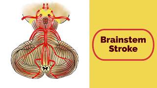 Brainstem Stroke Syndromes [upl. by Batruk987]