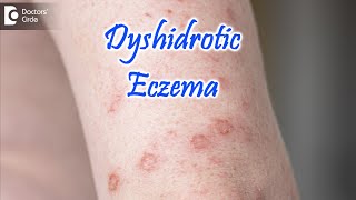 Dyshidrotic Eczema  POMPHOLYX   Causes Symptoms amp Treatment  Dr Nischal K  Doctors Circle [upl. by Quirita685]