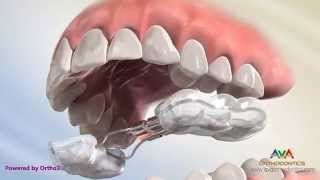 Orthodontic Expander or Spacer  Bonded RPE Appliance [upl. by Avonasac]