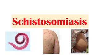 Schistosomiasis  Bilharziasis  Causes Symptoms and Treatment [upl. by Ydeh]