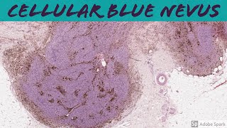 Cellular Blue Nevus 5Minute Pathology Pearls [upl. by Graces]