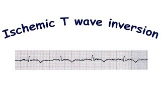 Mechanism of ischemic T wave inversion [upl. by Oikim]