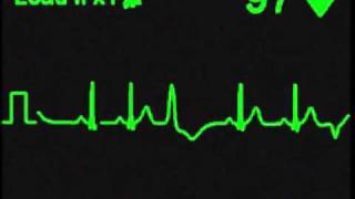 Multifocal Premature Ventricular Contractions PVCs [upl. by Arretal]