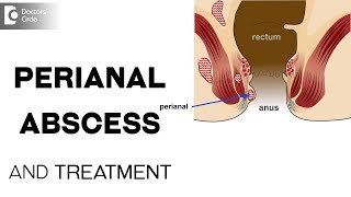 What is perianal abscess and its treatment  Dr Prashanth Varadaraju [upl. by Haden]