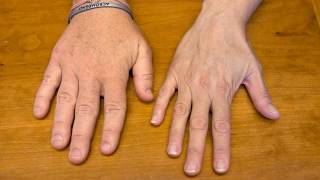 Difference Between Gigantism and Acromegaly [upl. by Ztnaj]