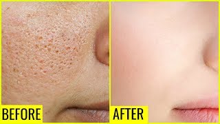 How to Get Rid of Large OPEN PORES Permanently  Anaysa [upl. by Bennink]