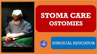 STOMA CARE OSTOMIES [upl. by Wain145]