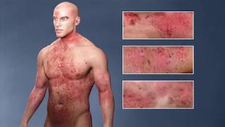 Contact Dermatitis Explained dermatitis [upl. by Cheria]