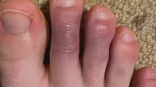 What are COVID toes [upl. by Notlit]