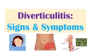 Diverticulitis Signs amp Symptoms And Why They Occur [upl. by Oberg889]