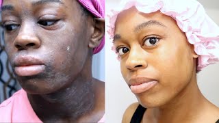 Eczema Treatment Journey  This Skincare Routine Changed My Life  DeSade [upl. by Barbaresi]