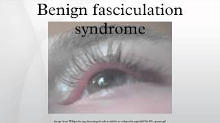 Benign fasciculation syndrome [upl. by Marozas845]