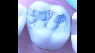 Class II Amalgam Restoration 1  Operative Dentistry [upl. by Yvon]