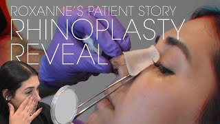 How to clean your nose after rhinoplasty [upl. by Ttenyl]