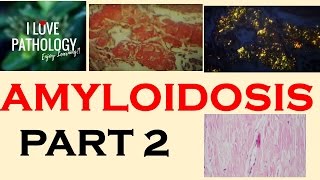 AMYLOIDOSIS PART 2 Pathogenesis amp Classification [upl. by Rorrys765]