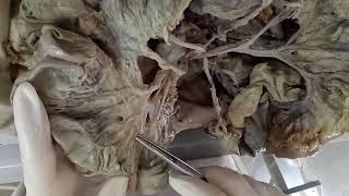 INTESTINES  BY DR MITESH DAVE [upl. by Notaes166]