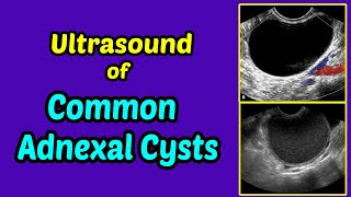 His and Hers Extractions Blackheads amp A Cyst [upl. by Ernaline]