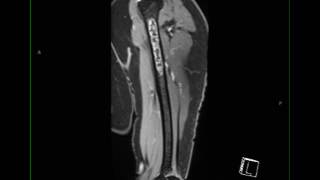 Conventional Chondrosarcoma Humerus [upl. by Malik]