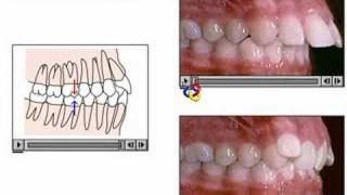clase II ortodoncia [upl. by Ecinnahs]