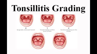 Tonsillitis Grading [upl. by Onairotciv432]