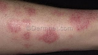 HOW I STOPPED DYSHIDROTIC ECZEMA AND BLISTERS FOR GOOD [upl. by Stella830]