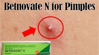 How to use Betnovate N for pimples  Remove pimples overnight remedy [upl. by Yllen913]