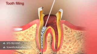 Root Canal Treatment [upl. by Nnuahs]