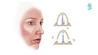 Rhinoplasty Detailed animation about the operation [upl. by Teeter]