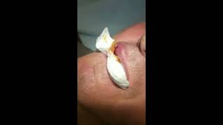 Botfly Larva Removal from lip [upl. by Adnilemreh698]