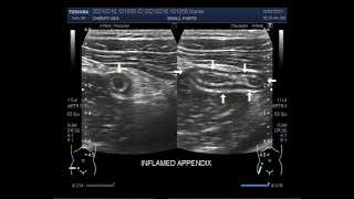 Anterior Hip and Iliopsoas Tendon with Dr Steven Arnold  AMSSM Sports Ultrasound Case Presentation [upl. by Anoiuq631]