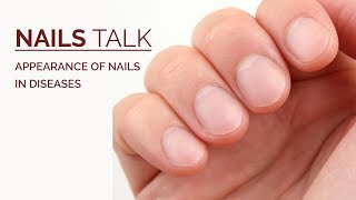 How Do Nails Help in Diagnosing Systemic Disease  Nail Abnormalities in Systemic Diseases [upl. by Tyne8]