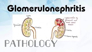 Glomerulonephritis Pathology [upl. by Colt]