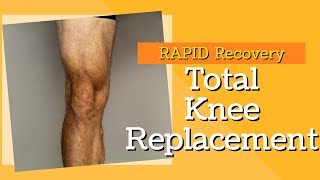 8 Exercises To Prevent Runners Knee  Stop Knee Pain From Running [upl. by Shirl]