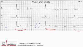 ECG Interpretation Tutorial  ChalkTalk 03  Advanced Level [upl. by Eldrid]