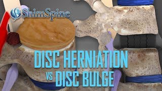 Disc Herniation vs Disc Bulge [upl. by Malony182]