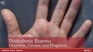 Dyshidrotic Eczema  Overview Causes and Diagnosis [upl. by Htebezile714]