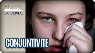 Conjuntivite Sintomas Tratamento e Prevenção  Revista da Cidade 16082017 [upl. by Garibald724]