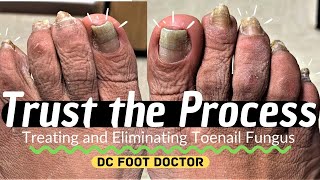 Trust The Process Treating and Eliminating Toenail Fungus [upl. by Gilda]