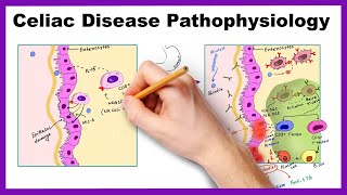 Understanding Coeliac Disease [upl. by Yelsehc]