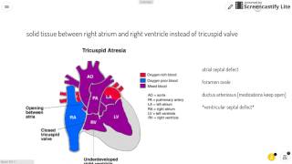 Tricuspid Atresia [upl. by Yadsendew]