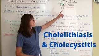 Cholelithiasis amp Cholecystitis [upl. by Arolf271]