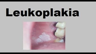 Leukoplakia [upl. by Amadeus]