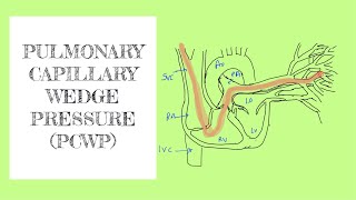 Pulmonary capillary wedge pressure PCWP [upl. by Linnie550]